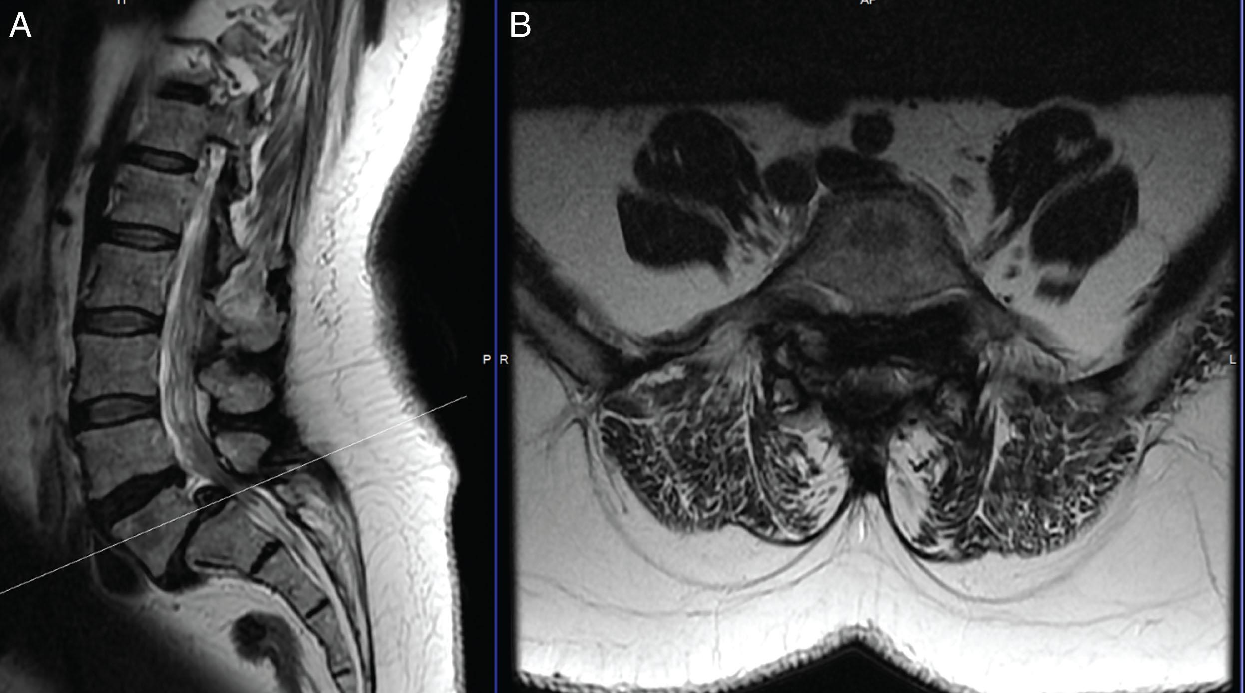 Fig. 10.1, (A) Sagittal T2-weighted magnetic resonance imaging demonstrating grade 2 L5–S1 spondylolisthesis with severe central stenosis. (B) Axial T2-weighted magnetic resonance imaging at the L5–S1 level.