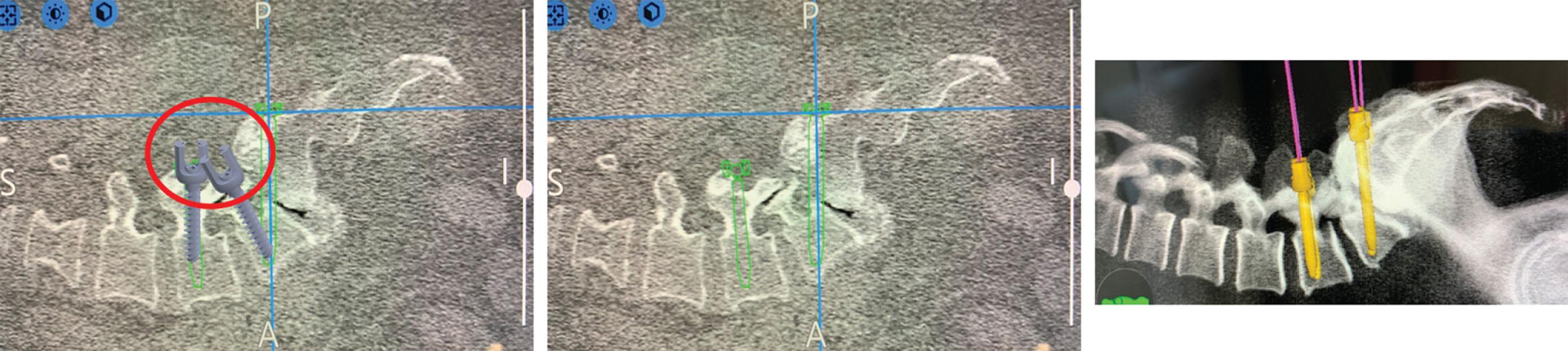 Fig. 10.2, Conventional pedicle screw placement was challenging due to the patient anatomy ( left ). Robotic-assisted trajectory planning and navigation allowed the placement of transvertebral screws ( right ).