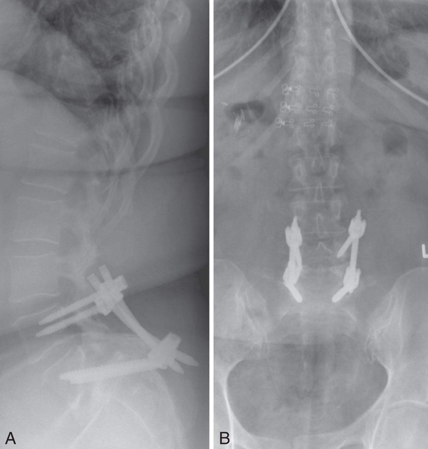 Fig. 10.3, Postoperative (A) lateral and (B) anterior-posterior views demonstrating accurate screw trajectories and intact instruments with no screw pull-out.