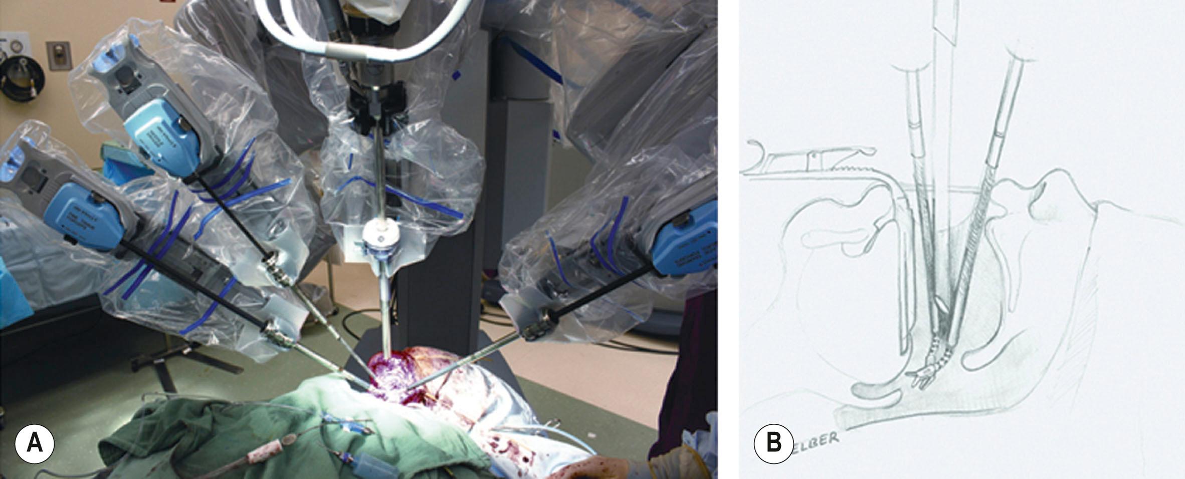 Figure 34.2, Transoral robotic reconstruction requires a mouth retractor to set the interdental opening. The robotic endoscope and two robotic instrument arms are introduced through the mouth and converge on the target oropharyngeal anatomy. External view ( A ) and depiction of internal view ( B ) are shown.