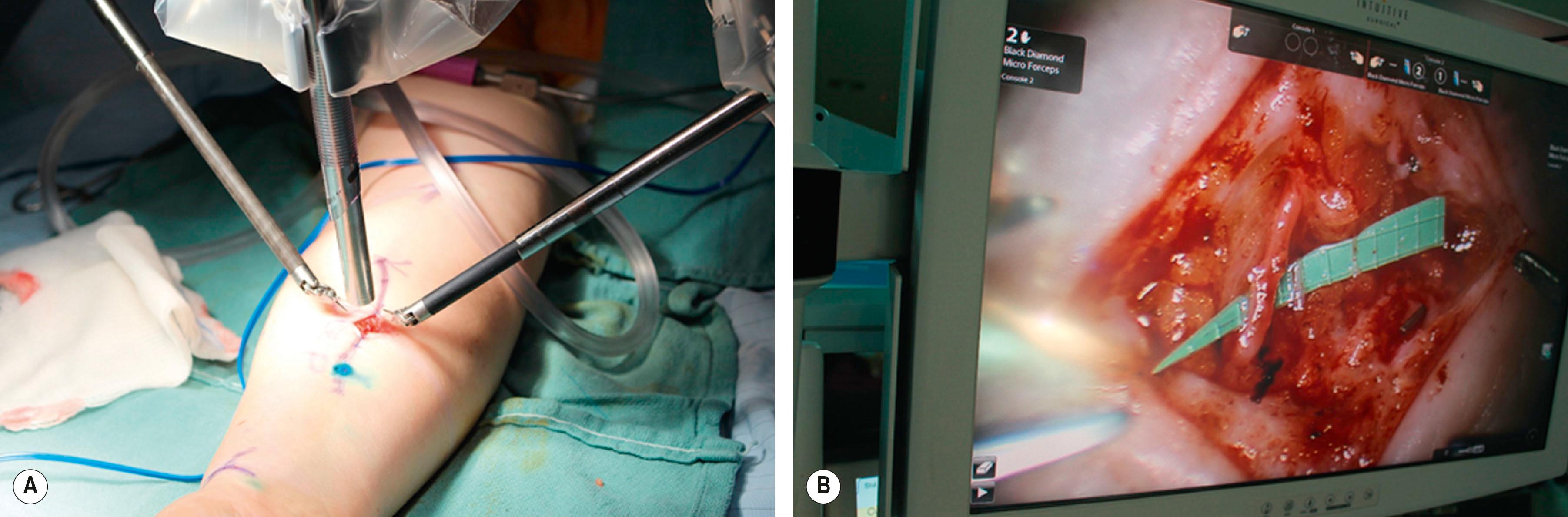 Figure 34.3, Robotic lymphovenous bypass. The robotic camera is positioned in the middle, and the two arms are on either side of the forearm (A) . Lymphovenous bypass completed (B) .