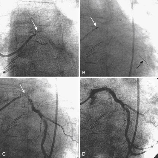 Fig. 35.3, Rotational atherectomy for uncrossable left main stenosis.