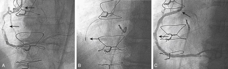 Fig. 35.4, Rotational atherectomy for uncrossable lesions in the right coronary artery.