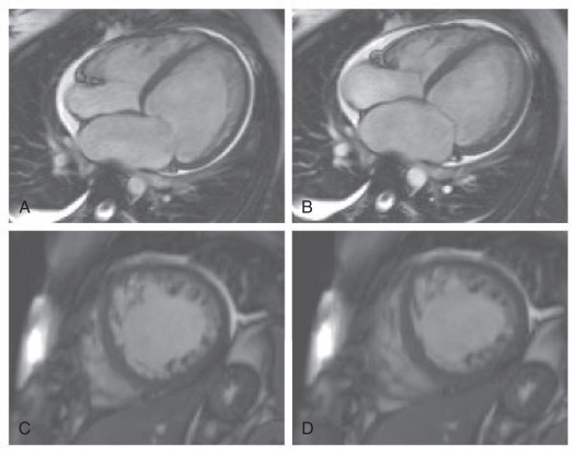 FIG. 31.1, Steady-state free precession images demonstrating biventricular dilatation with severe left ventricular systolic impairment, a small pericardial effusion, and right pleural effusion: (A) four chamber, end diastole; (B) four chamber, end systole; (C) mid-ventricular short axis, end diastole; (D) mid-ventricular short axis, endsystole.