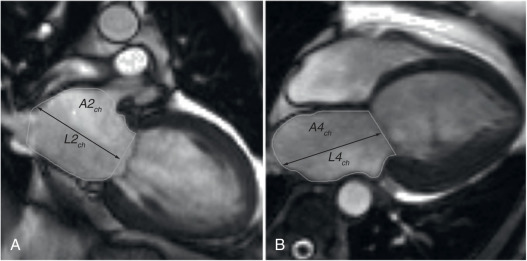 FIG. 31.2, Left atrial volume measurement using the biplane area-length method. The endocardial border is traced in two-chamber ( 2 Ch ; A) and four-chamber views ( 4 Ch ; B) in end systole, excluding pulmonary veins and left atrial appendage. The left atria length is measured from the midpoint of the mitral valve, perpendicularly, to the top of the atrium.