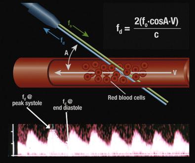 FIG 22-1, The Doppler effect (f d ) is dependent on the initial frequency of the ultrasound transducer (f 0 ), the velocity of flow (V) of the blood within a vessel, and the cosine of the angle (A) that the ultrasound beam makes with the direction of blood flow. The frequency shift (f d ) is displayed as a time-dependent plot within a cardiac cycle and is inversely proportional to the constant (c), which reflects a constant related to the medium in which the sound is traversing.