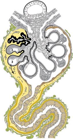 Figure. 86.3, Schematic illustration of the consequences of localized podocyte loss, with capillary loops adhering to Bowman’s capsule and becoming hyalinized, while fluid leaking through the damaged glomerular walls infiltrates between the nephron (glomerular tuft and tubule) and the adjacent interstitium. Organization of this material may lead to progressive destruction of the nephron.