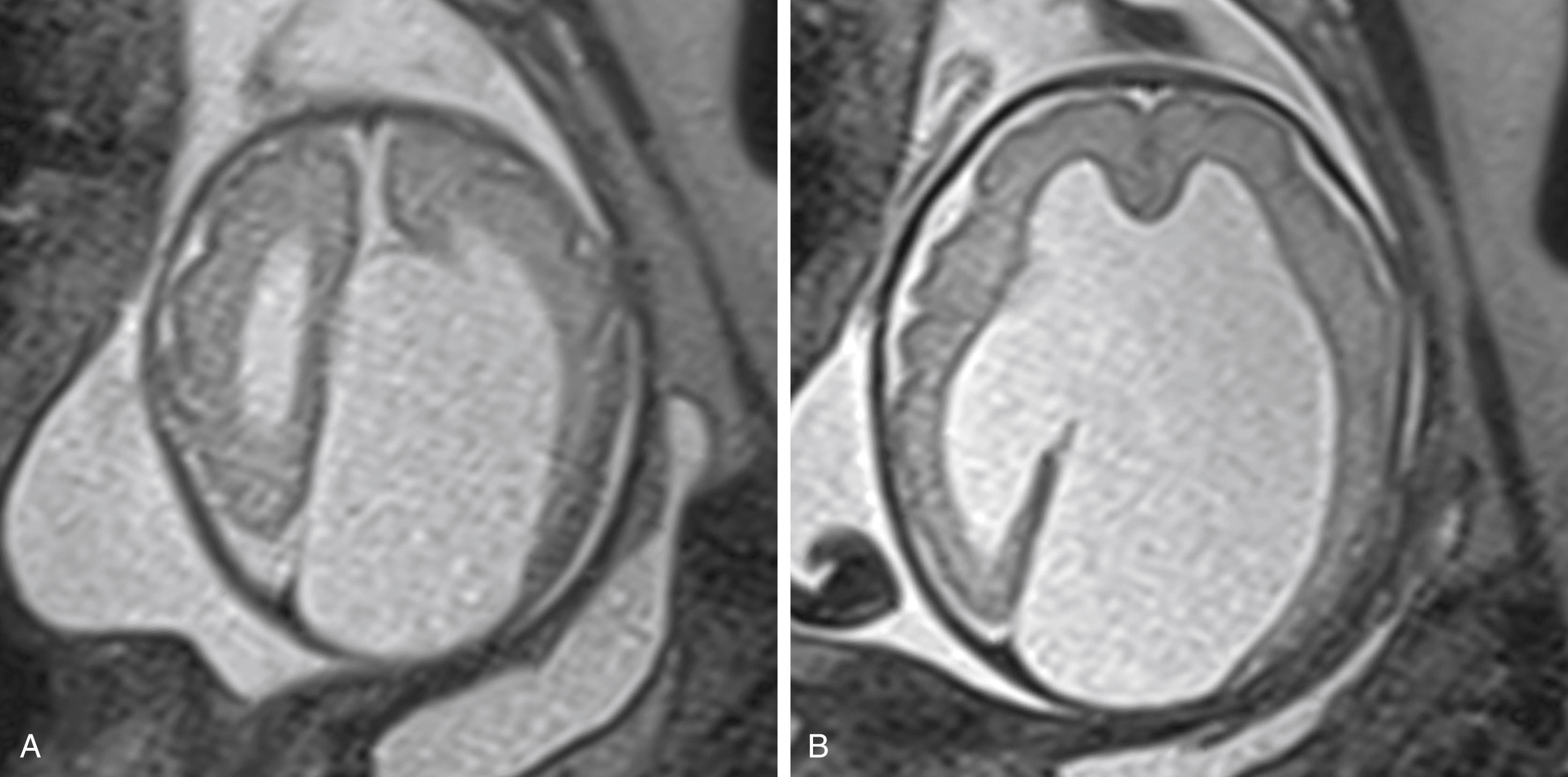 Figure 19.3, Axial magnetic resonance imaging in the AVID complex ( a symmetric v entriculomegaly, i nterhemispheric cyst, and d ysgenesis of the corpus callosum).