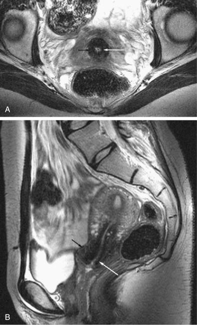 FIG 36-1, Normal cervix. Axial ( A ) and sagittal ( B ) T2-weighted images demonstrating the normal zonal anatomy of the cervix, composed of an outer rim of smooth muscle ( short black arrow on A and B) of intermediate signal intensity, a dark low signal intensity ring of fibrous stroma ( long white arrow on A and B), and the high signal intensity endocervical mucosa ( asterisk on A).