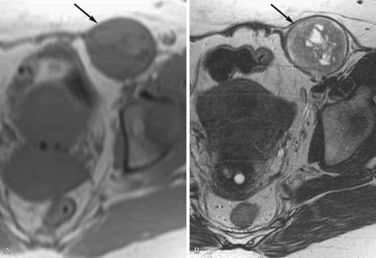 FIG 36-11, Round ligament leiomyoma. Axial T1-weighted ( A ) and T2-weighted ( B ) images demonstrate a round mass ( arrows ) with the typical appearance of a degenerating leiomyoma, predominantly low signal intensity on both sequences but with central irregular areas of high signal intensity on the T2-weighted image consistent with cystic degeneration. However, the mass is separate from the uterus and has herniated into the left inguinal canal. This mass was surgically proved to be a leiomyoma of the round ligament.