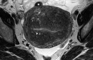 FIG 36-14, Leiomyoma and adenomyosis. Axial T2-weighted image demonstrates a small low signal intensity subserosal leiomyoma anteriorly ( asterisk ). The junctional zone is markedly thickened and has indistinct margins. Multiple punctate foci of high signal intensity (starry sky appearance) ( arrowhead ), characteristic of adenomyosis, are seen.