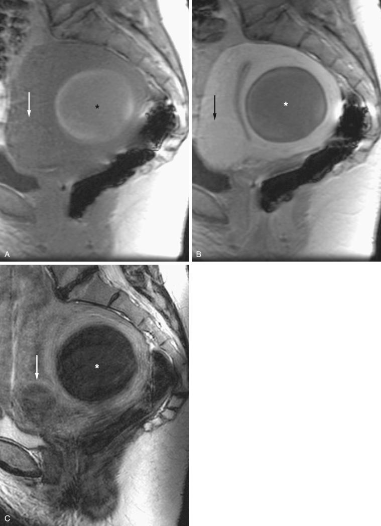 FIG 36-15, Hemorrhagic degeneration of uterine leiomyoma. Nonenhanced ( A ) and gadolinium-enhanced ( B ) sagittal T1-weighted fat-suppressed and sagittal T2-weighted ( C ) images demonstrate high signal intensity consistent with blood products in the largest leiomyoma ( asterisk ) on the T1-weighted image (A). This leiomyoma ( asterisk ) becomes slightly heterogeneous and lower in signal intensity on the T2-weighted image (C) consistent with hemorrhage. No enhancement of the leiomyoma ( asterisk ) is seen after contrast agent administration (B). A second smaller leiomyoma seen anteriorly ( arrow ) has the typical T2 low signal intensity (C) and enhancement pattern (B) of a nondegenerating leiomyoma, but is slightly hyperintense on the T1-weighted image (A), suggesting a small amount of internal hemorrhage.