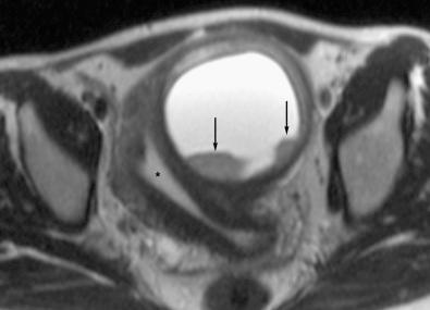 FIG 36-16, Uterine sarcoma. Axial T2-weighted image. The high signal intensity endometrial cavity ( asterisk ) is displaced by a large cystic (high signal intensity central component) myometrial mass that contains intermediate signal intensity mural nodules ( arrows ) posteriorly; pathologic examination proved the mass to be a uterine sarcoma.