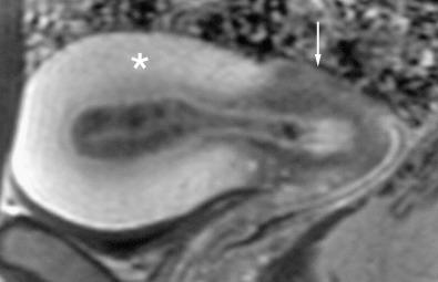 FIG 36-4, Normal uterus. Gadolinium-enhanced sagittal T1-weighted fat-suppressed image demonstrates the normal difference between enhancement of the myometrium ( asterisk ) and cervical stroma ( arrow ).