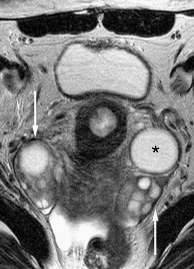 FIG 36-5, Normal ovaries. Axial T2-weighted image demonstrates the presence of multiple hyperintense follicles in both ovaries ( arrows ), one of which represents the dominant follicle ( asterisk ).
