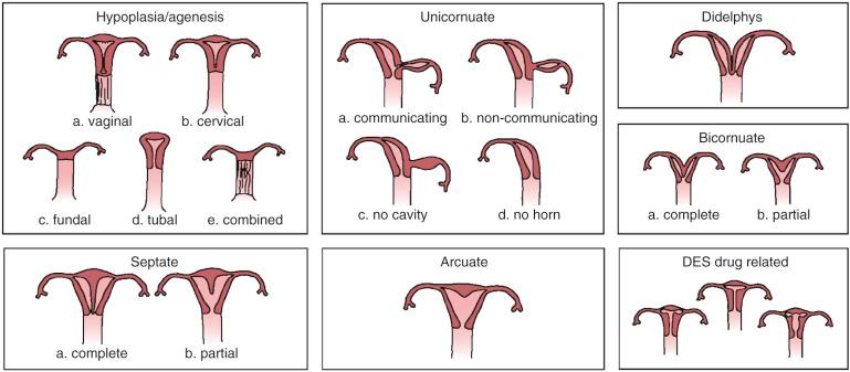 FIG 36-6, Classification of müllerian duct anomalies used by the American Society for Reproductive Medicine. DES, diethylstilbestrol.