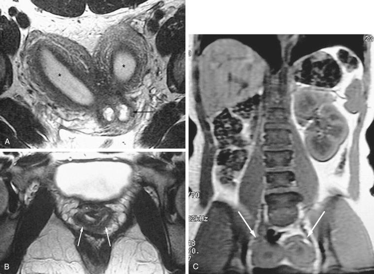 FIG 36-7, Uterus didelphys. Axial T2-weighted images of the pelvis ( A and B ) and coronal T1-weighted image of the abdomen ( C ) demonstrate two separate uteri ( asterisks on A and arrows on C) and cervices ( black arrow on A), as well as two separate vaginas ( white arrows on B). The right kidney was congenitally absent (C).