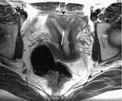 FIG 36-9, Septate uterus. Axial T2-weighted image demonstrates a partial septum dividing the endometrial cavity ( arrow ) and a flat fundal contour ( arrowhead ).