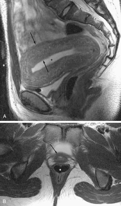 FIG 36-10, Vaginal agenesis. Sagittal T2-weighted ( A ) and axial T2-weighted ( B ) images demonstrate mild distention of the uterine cavity ( asterisk on A) and thickening of the myometrium ( arrows on A) as well as absence of the vagina between the normal urethra ( arrow on B) and rectum ( asterisk on B).