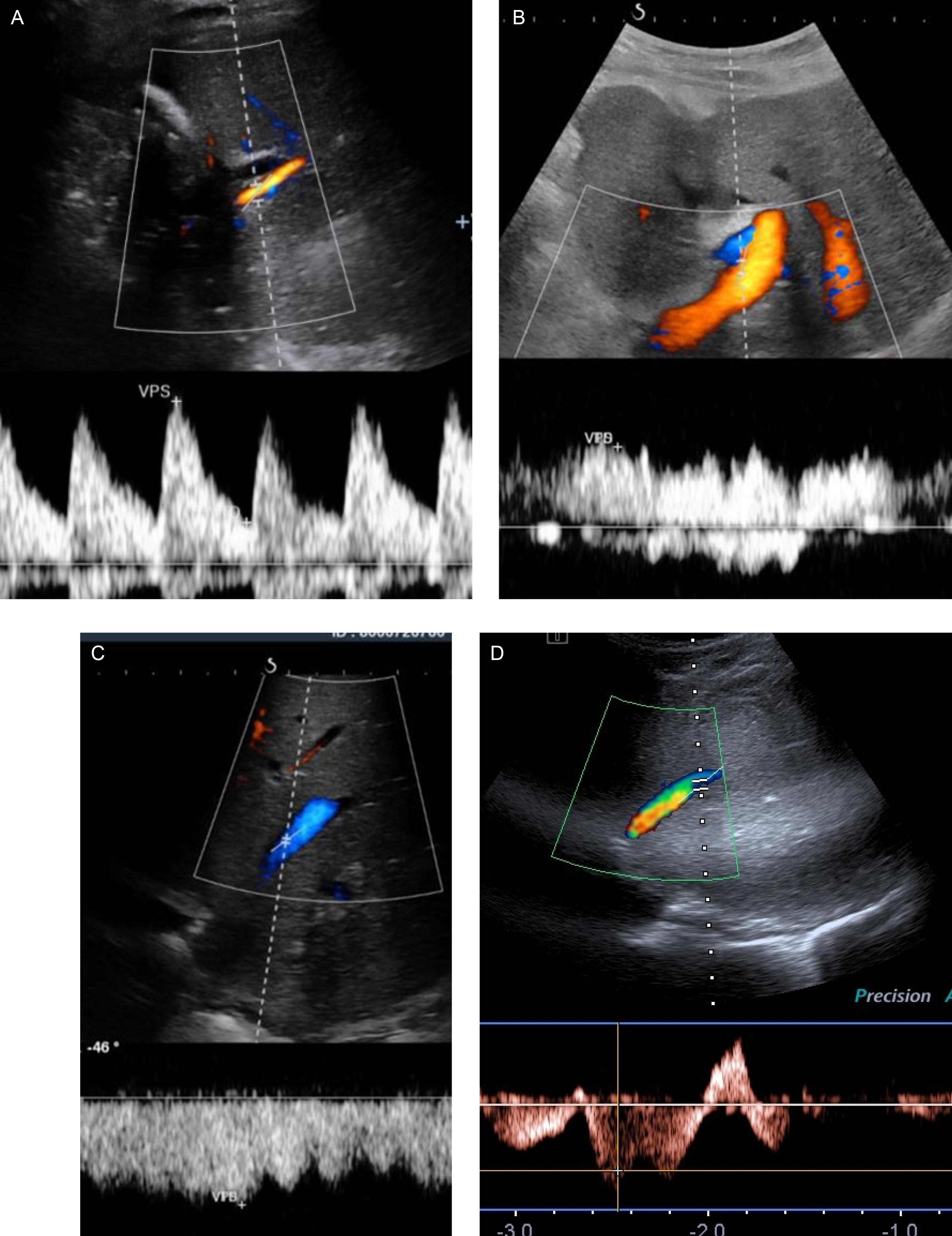 Fig. 29.1, Normal pulsed Doppler appearance of a hepatic graft artery (A), portal vein, and hepatic vein (B), with monophasic flow (C) and triphasic flow (D).