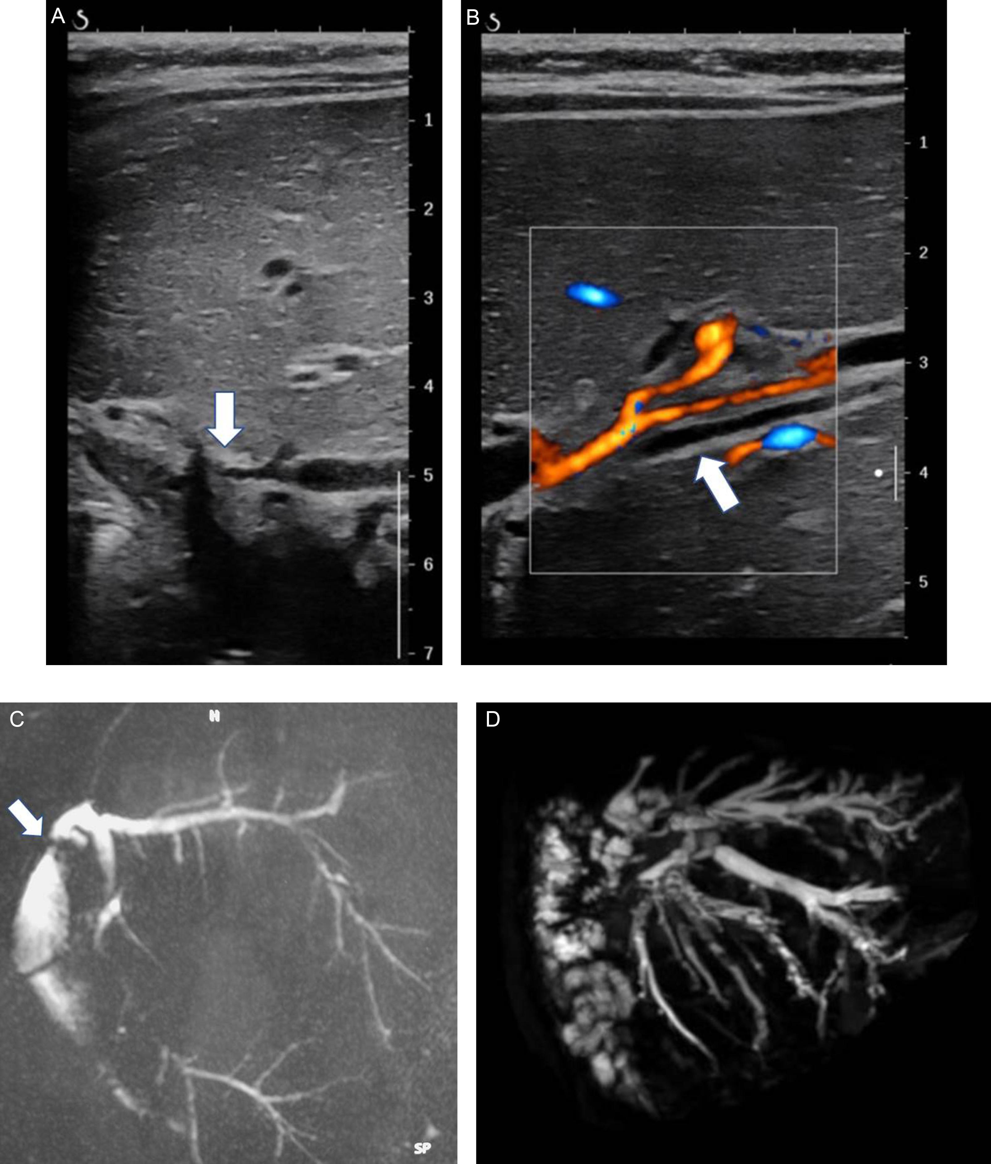 Fig. 29.2, Appearance of the bile ducts on ultrasonography (US) and magnetic resonance cholangiopancreatography (MRCP) in biliary complications in liver recipients with a left lobe graft. (A) US color Doppler allows distinguishing vessels that are color-encoded from bile ducts that remain anechoic. In this case, there is a dilation of the bile duct (arrow). (B) US can clearly show intrahepatic biliary stenosis (arrow). (C) MRCP three-dimensional reconstructions allow analysis of the entire biliary tree. This coronal view shows the diffuse, regular, biliary dilation related to the stenosis of the bilioenteric anastomosis ( arrow ). (D) This coronal view shows a diffuse irregular dilation of the bile ducts, with intraluminal stones related to diffuse ischemic cholangiopathy (history of septic shock shortly after pediatric liver transplantation several years before).