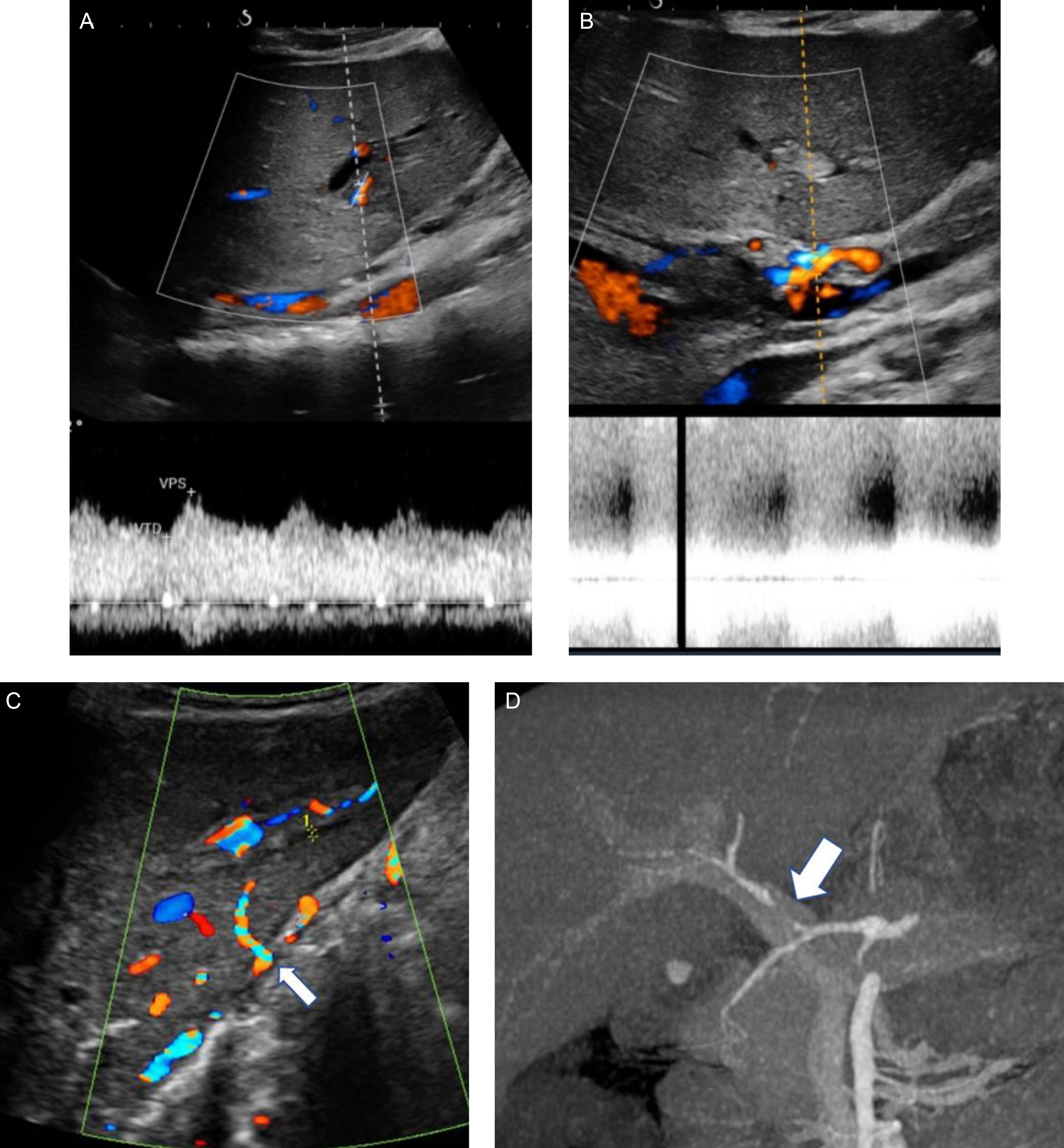 Fig. 29.3, Typical imaging patterns of hepatic artery stenosis. (A) Doppler ultrasonography (US Doppler) appearance of tardus parvus. (B) US Doppler image showing acceleration at the site of stenosis. (C) Hepatic artery thrombosis. Shown are numerous small collateral arteries crossing the liver capsule and restoring arterial flow in the graft (arrow). (D) Appearance on computed tomography (CT) angiography (angio-CT) at the arterial phase showing the short circumferential stenosis of the hepatic artery at the anastomosis site (arrow).