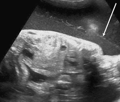 FIG 24-2, Chorioamniotic separation noted, with amniotic fluid seen on either side of the membrane ( arrow ), following fetal procedure.