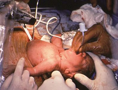 FIG 24-3, EXIT (ex utero intrapartum therapy) procedure. Photograph obtained following reversal of fetal tracheal occlusion for congenital diaphragmatic hernia demonstrates intubation of the neonate while placental umbilical circulation is maintained.