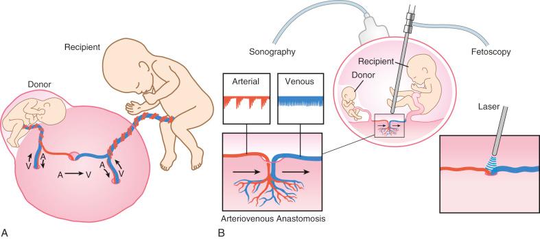 FIG 24-4, A, Monochorionic twin placenta, demonstrating arteriovenous vascular (A → V) connection. B, Diagram illustrating sonographic guidance for laser ablation for twin-twin transfusion syndrome. Doppler interrogation is used to identify arterial and venous connections, and laser energy is applied to the site of anastomosis.