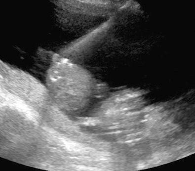 FIG 24-5, Laser for twin-twin transfusion syndrome. Fetoscope can be seen adjacent to twin A in the polyhydramniotic sac. The placenta is posterior.