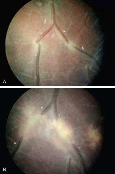 FIG 24-6, Fetoscopic image of the fetal surface of a monochorionic twin placenta in the region of the vascular equator. Two placental arteries (a) from the donor twin communicate with placental veins (v) of the recipient twin, shown before ( A ) and after ( B ) laser photocoagulation.