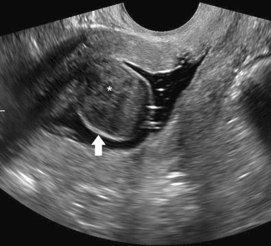 FIG 37-1, Submucosal, predominantly intracavitary leiomyoma ( asterisk ) well demonstrated by saline infusion sonohysterography on this sagittal transvaginal ultrasound image. Note the thin overlying rim of echogenic endometrium ( arrow ) covering the myoma.
