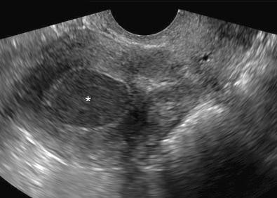 FIG 37-2, Hematometra following incomplete endometrial ablation. This 51-year-old patient presented with crampy pelvic pain but no bleeding. Transvaginal sagittal image of the uterus demonstrates the endometrial cavity distended with homogeneous hypoechoic material ( asterisk ) that was avascular on color Doppler imaging (not shown). The patient spontaneously bled and decompressed 1 day before her planned cervical dilation.