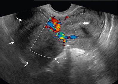 FIG 37-3, Pedunculated leiomyoma. Transaxial transvaginal color Doppler sonogram of the uterus demonstrating an echogenic focus ( large arrow ) with associated posterior shadowing within the endometrium, indicating an intrauterine device. Note right-sided hypoechoic solid mass ( small arrows ) in direct continuity with the myometrium, consistent with a large pedunculated subserosal leiomyoma. Note that color Doppler sonogram imaging can be used to show bridging myometrial vessels.