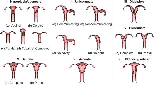 FIG 37-4, Diagram representing the American Fertility Society/American Society of Reproductive Medicine (AFS/ASRM) classification system for müllerian anomalies. 30 31 DES, diethylstilbestrol.