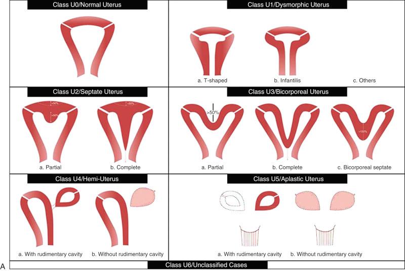 FIG 37-5, European Society of Human Reproduction and Embryology (ESHRE)/European Society for Gynaecological Endoscopy (ESGE) classification of female genital tract congenital anomalies. A, Diagram. B, Related description. Box provided for sketch of anomaly by interpreting physician.