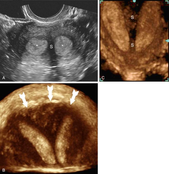 FIG 37-6, Three different patients with septate uterus. A, Two-dimensional (2D) transverse transvaginal ultrasound image shows two portions of the divided endometrial cavity ( asterisks ) with intervening hypoechoic septum (S). B, Three-dimensional (3D) sonographic coronal display of a septate uterus demonstrating the important feature used to distinguish this type of anomaly from a bicornuate uterus. Note the preserved, outwardly convex, smooth external uterine contour ( arrows ). C, 3D ultrasound coronal image shows the dividing uterine septum (S) extending from the fundus caudally to the cervix.