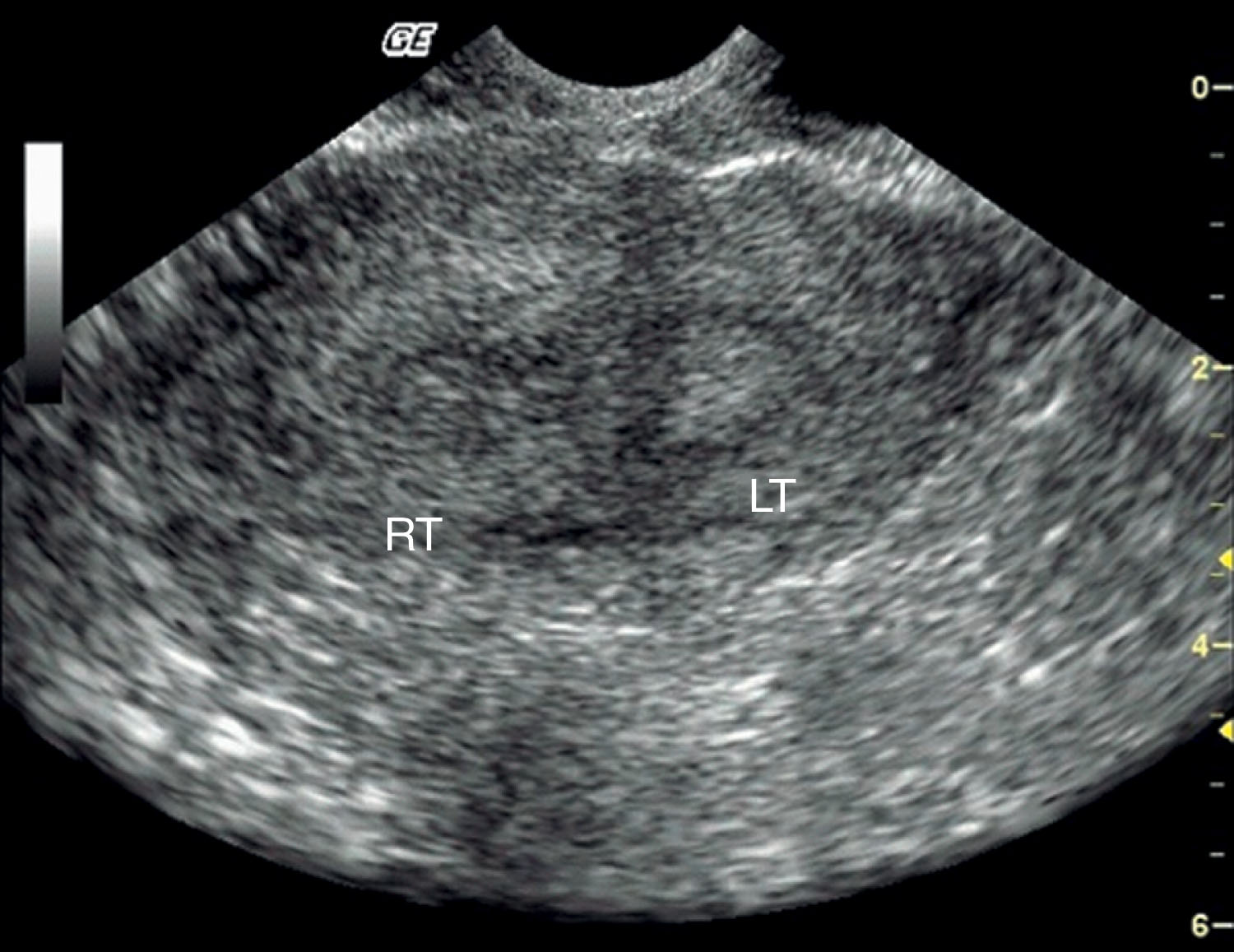 Fig. 46.1, Bicornuate uterus. LT , Left; RT , right.