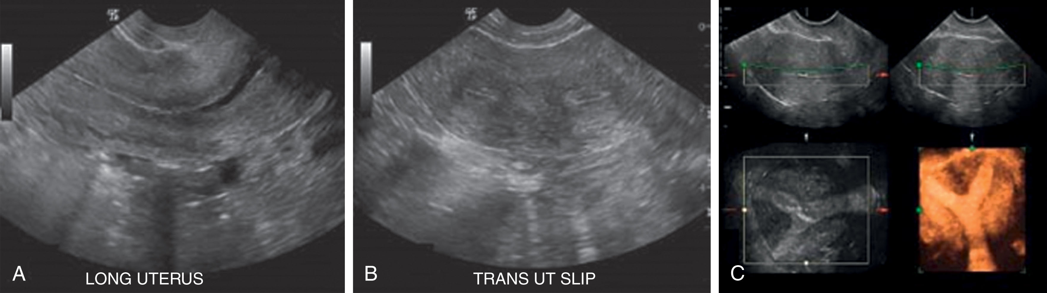 Fig. 46.3, (A) Longitudinal image of the uterus. (B) Transverse image of the uterus. (C) Three-dimensional reconstruction of the same patient demonstrating a septate uterus.