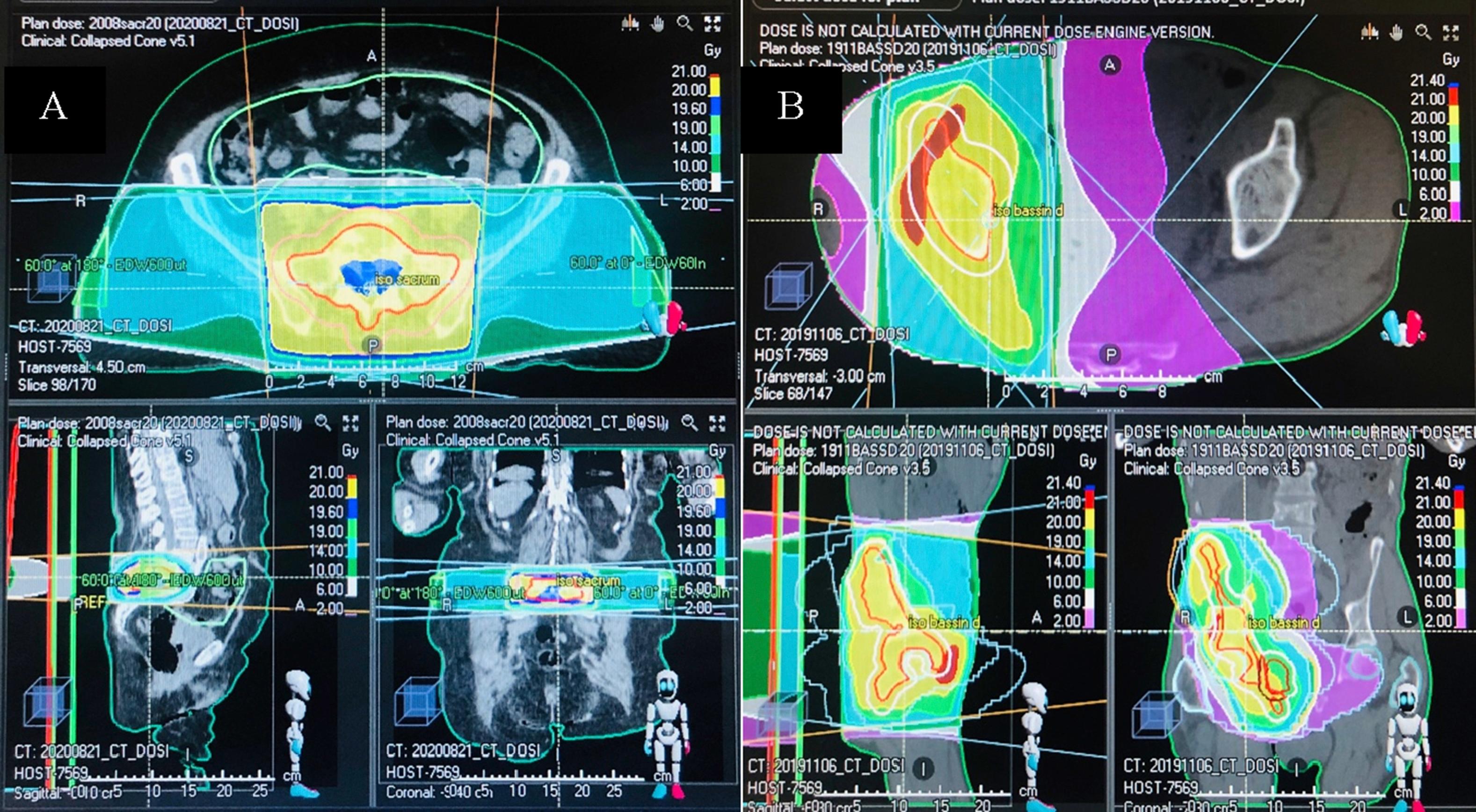 Figure 61.2, (A) Analgesic and decompressive radiation therapy of bilateral roraminal S1 epiduritis in metastatic pulmonary carcinoma. (B) Analgesic radiotherapy of the right hemi-pelvic.