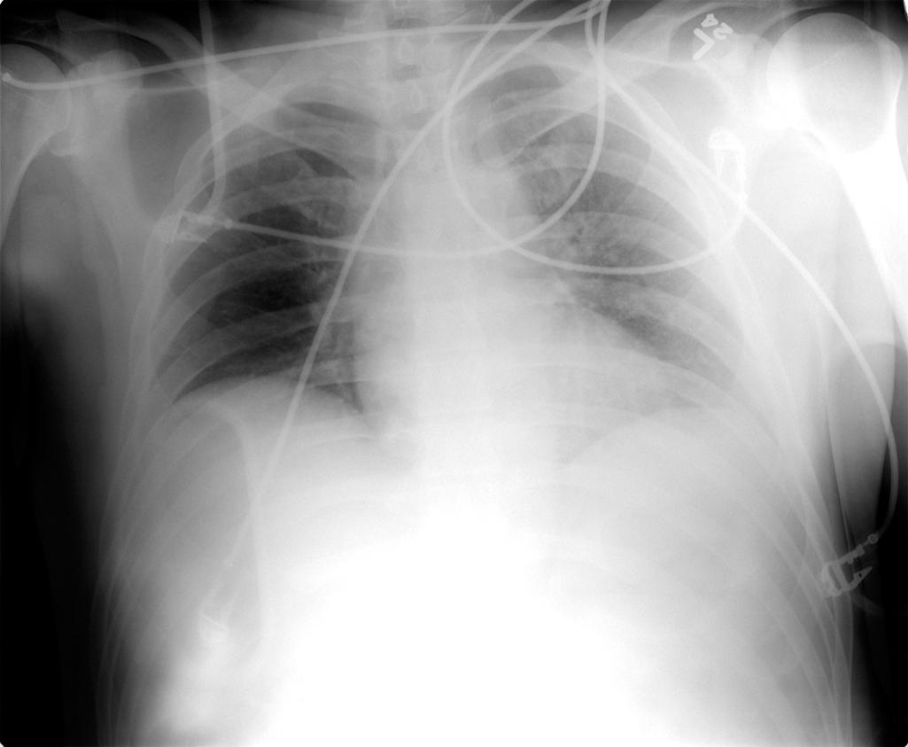 FIGURE 1, Typical chest radiograph in a trauma patient illustrates features that limit sensitivity in evaluating the chest. The chest in this patient was normal other than an old clavicle fracture. The lung volumes are low, which makes the lung appear hazy. This could be taken as a false-positive for contusion. The backboard and overlying wires obscure parts of the bones and the chest, altering normal densities. Because of the supine position and low volumes, the heart and mediastinum appear wide, which is normal for this kind of study but could result in a missed mediastinum injury.