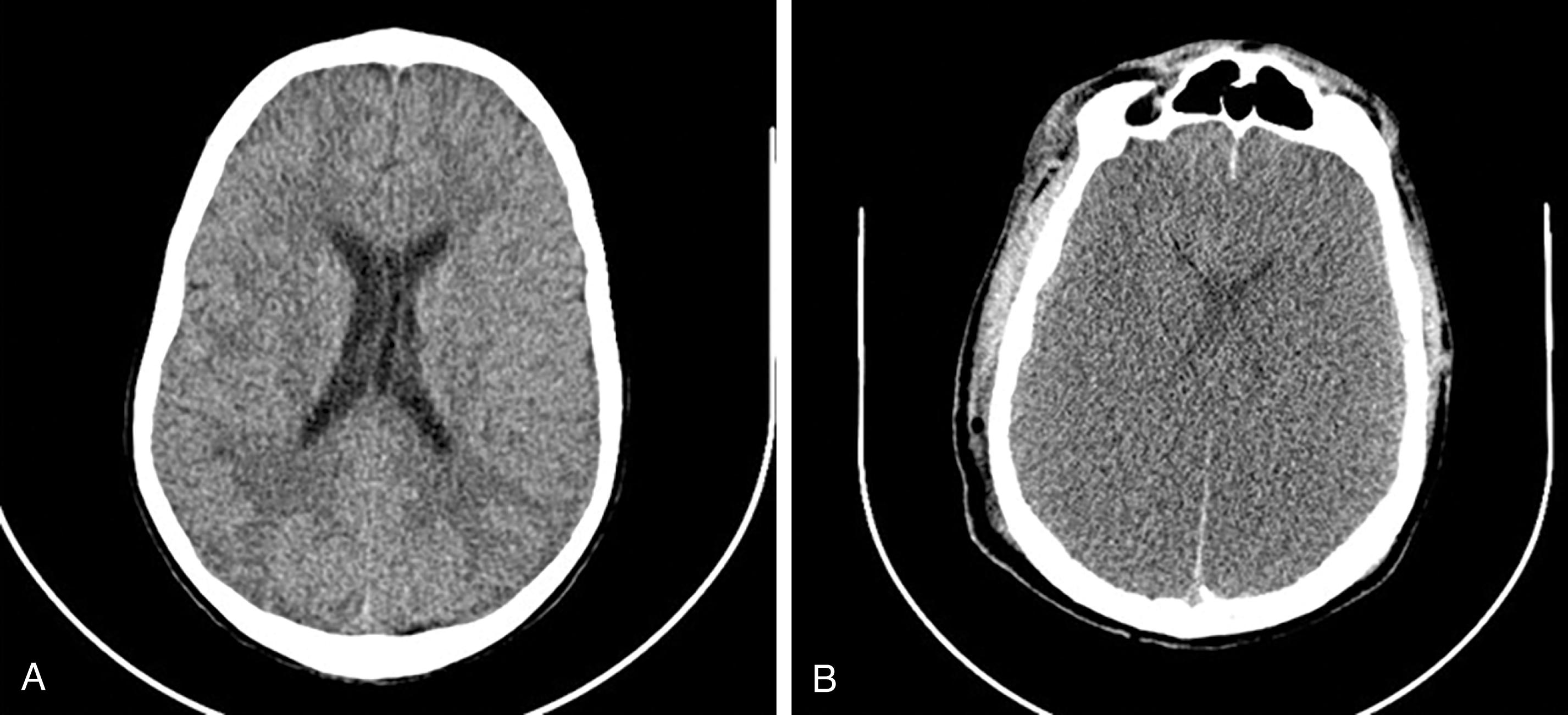 FIGURE 13, (A) Noncontrast axial CT of the brain demonstrates normal sulcal pattern and preserved gray-white matter differentiation. (B) Noncontrast axial CT of the brain in brain death demonstrates diffuse sulcal effacement and loss of gray-white matter differentiation. (C) Computed tomography angiography (CTA) maximum intensity projected (MIP) images of the head and neck demonstrate normal opacification of the cervical and intracranial carotid vasculature. (D) CTA MIP images of the head and neck in brain death demonstrate loss of opacification of the high cervical and intracranial carotid vasculature. (E) Brain death. Three-dimensional MIP images demonstrate loss of opacification of the high cervical and intracranial segments of the carotid vasculature.