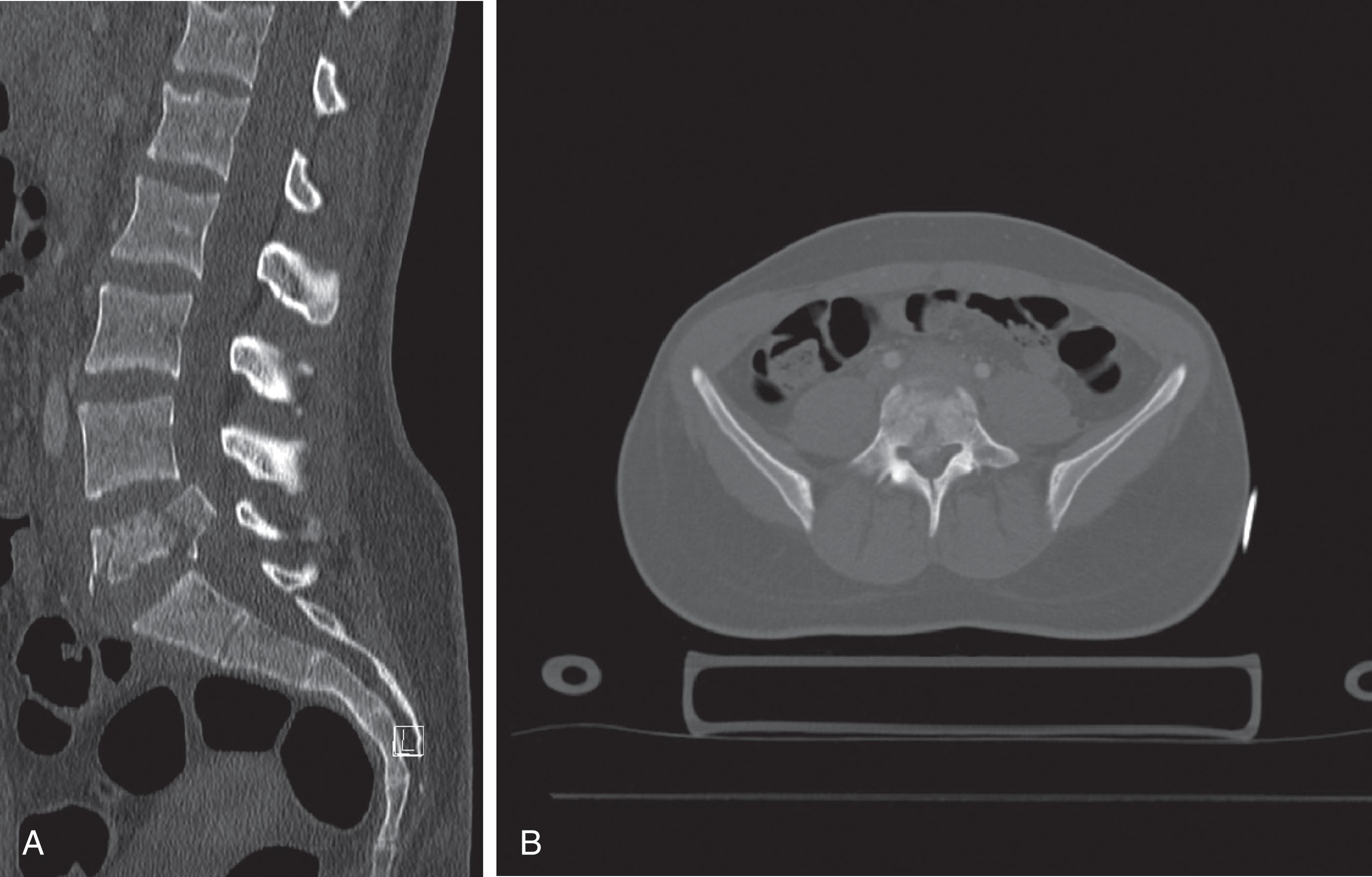 FIGURE 14, (A) Computed tomography angiogram, sagittal reconstructed image, and (B) axial image of the lumbar spine. Note L5 burst fracture with bony retropulsion into the spinal canal.