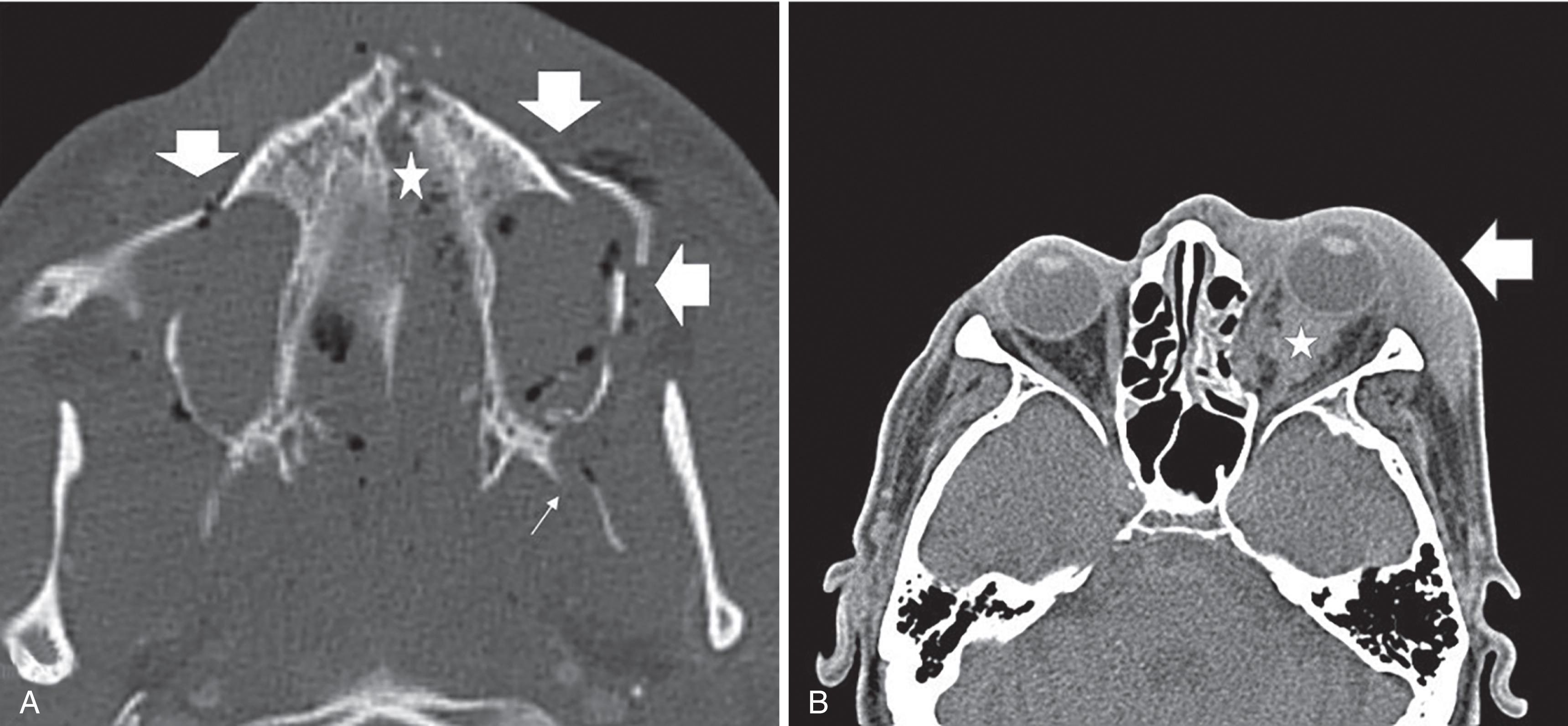 FIGURE 15, (A) Noncontrast axial CT of the face demonstrates fractures of the maxillary sinus walls (block arrows) , maxilla/hard palate (star) , and left lateral pterygoid plate (thin arrow) . Opacified maxillary sinuses consistent with hemosinus. (B) Noncontrast CT of the orbits demonstrates left preseptal/periorbital soft tissue swelling/hematoma (arrow) , depressed lamina papyracea fracture, and retrobulbar hematoma (star) .