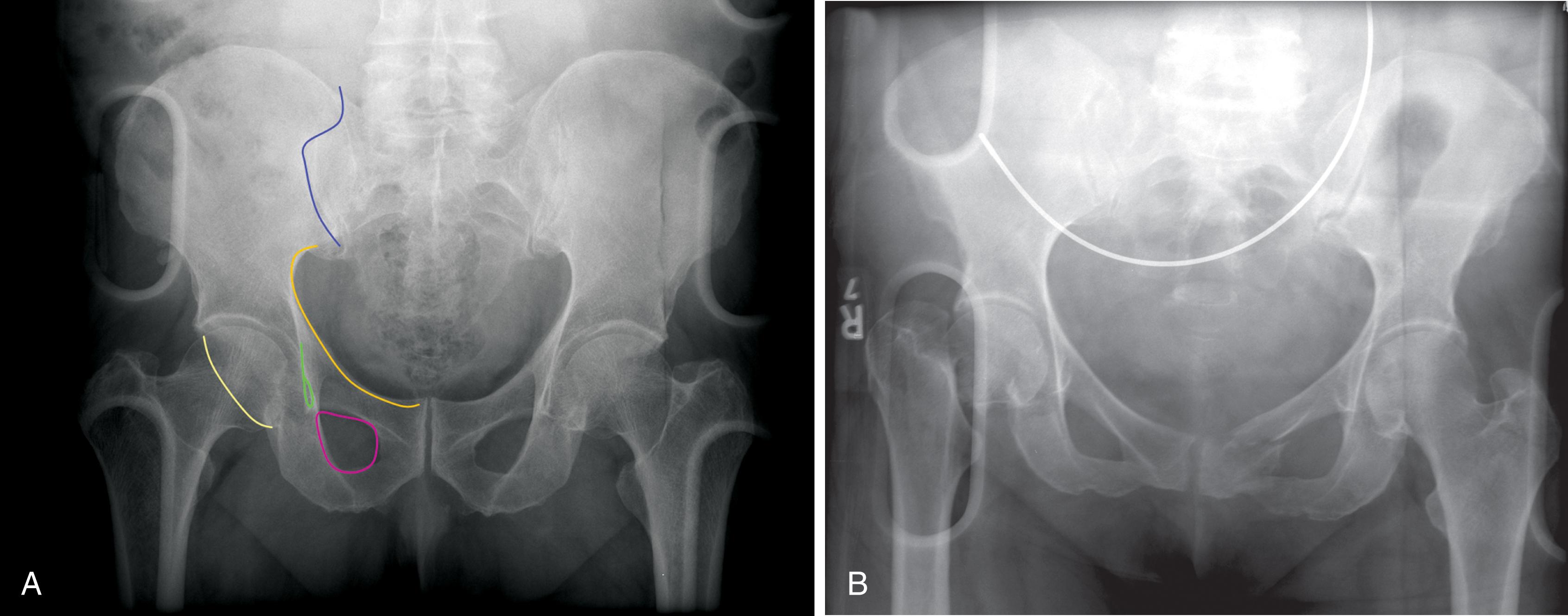 FIGURE 2, Radiographs of a normal (A) and a fractured (B) pelvis in two different patients. In both radiographs the backboard interferes with image quality, decreasing sensitivity for fracture. (A) A dark line along the left iliac bone is an artifact. Physicians should be cautious when reading these limited examinations. At minimum, the following lines should be glanced at to ensure they are smooth and regular: iliopectineal line (orange) reflecting the anterior column, sacroiliac joint (blue) , obturator ring (pink) assesses the pubic rami, teardrop (green) reflects the medial acetabular wall and the acetabular notch and anterior portion of the quadrilateral plate, and the posterior rim of the acetabulum (yellow) . (B) Fractures of the right femoral neck, right inferior pubic ramus, left superior, inferior rami, and the left pubic bone. The sacroiliac joint on the left side is slightly widened.