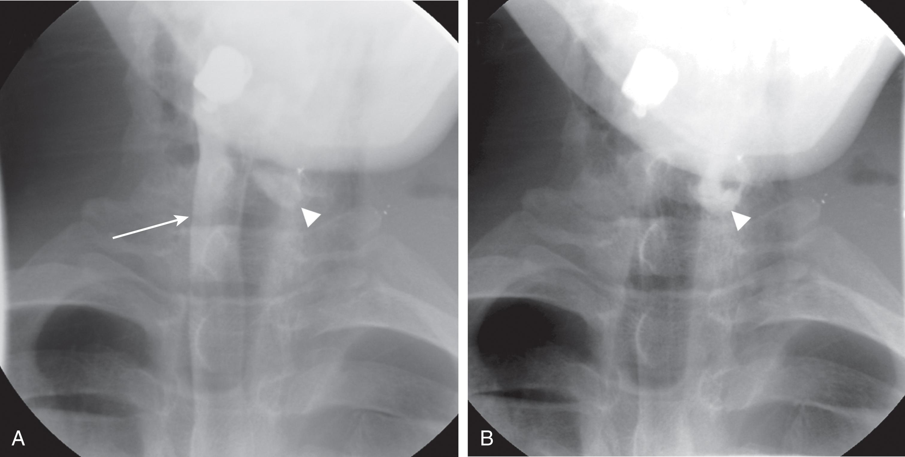 FIGURE 3, Esophagogram during (A) and immediately after (B ) swallowing gastrografin. (A) The column of contrast material is seen in the esophagus (arrow) and a small outpouching of contrast material begins to form (arrowhead) . The contrast material persists after the esophagus is cleared (B) , indicating that it has leaked. In the setting of a gunshot wound as illustrated by the metallic shrapnel, this is most likely posttraumatic.