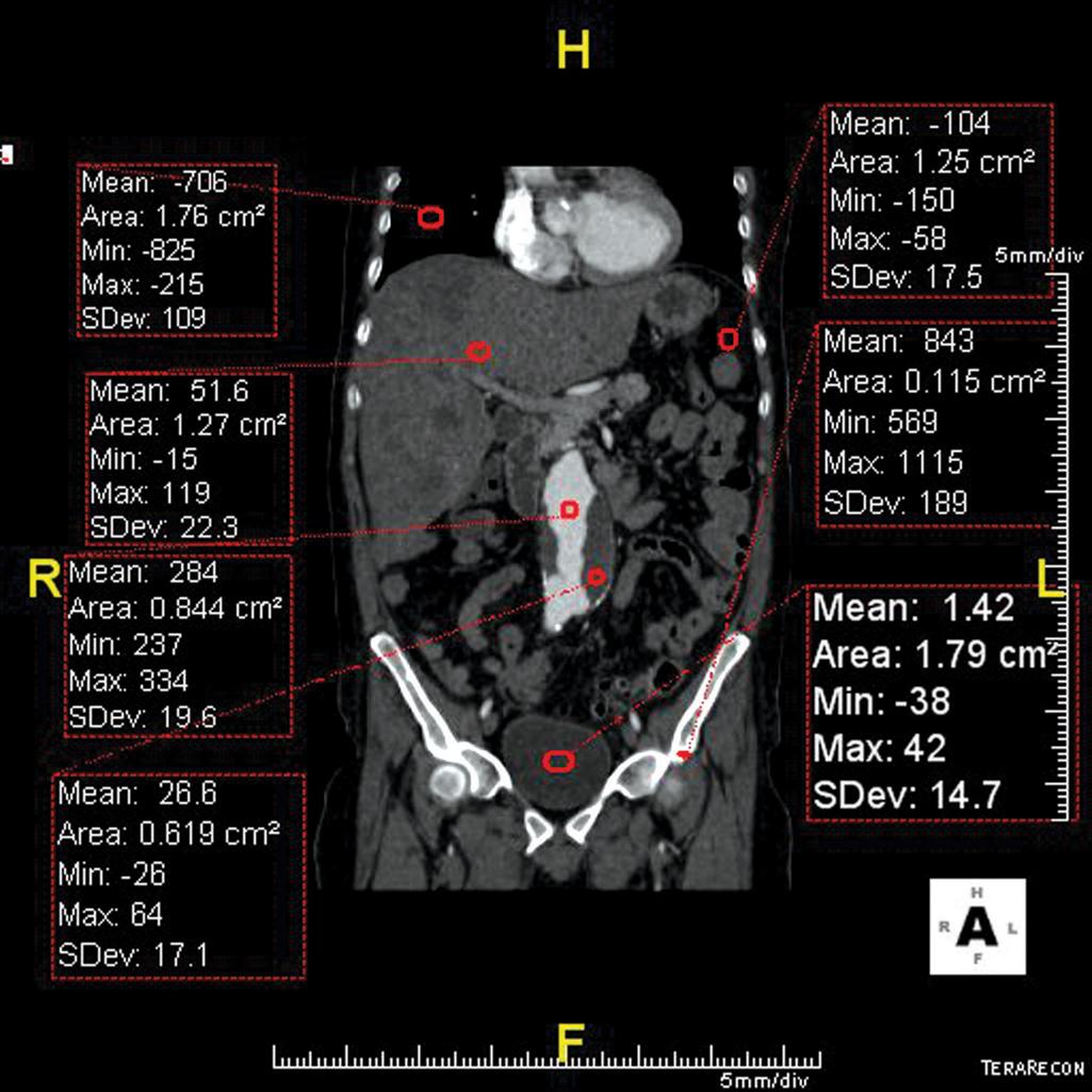 FIGURE 5, Coronal view of the abdomen and pelvis shows different Hounsfield units (HU) of the circled tissue. Notice that the mean HU value is calculated based on all the pixels in the circled area and as such, the minimum, maximum, and standard deviation are calculated. Mean HU values in this patient are as follows: lung −706, liver 51.6, enhanced aorta 284, aortic thrombus 26.6, fat −104, cortical bone 843, and urine 1.42.