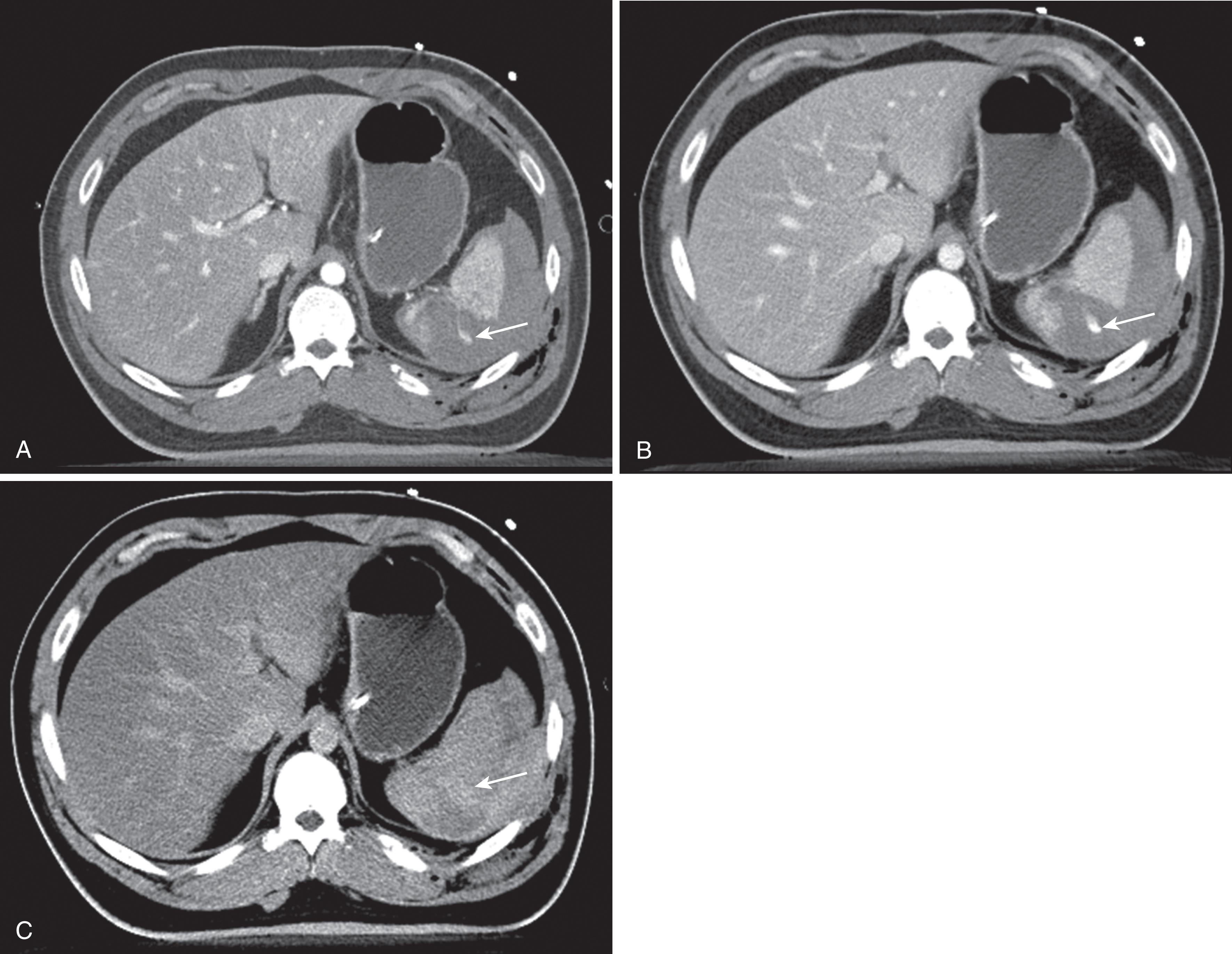 FIGURE 6, Active extravasation and computed tomography (CT) phases. Multiple axial CT images of the abdomen were obtained in this patient with trauma to the left abdomen in arterial (A), portal venous (B), and 5-minute delayed (C) phases. The aorta clues the reader to the phase as it is brightest in arterial, less bright in portal venous, and darkest in the delayed phases. A grade IV splenic laceration is seen in all images. A wisp of contrast material on the arterial phase (A) marked by the arrow shows what could be either extravasated contrast agent or something dense like a calcification. On the portal venous phase (B) it changes shape, indicating the finding is extravasating contrast agent. On the delay phase, the contrast agent is spread out in a blush and is denser than surrounding fluid but similar to vascular structures. This confirms active extravasation.