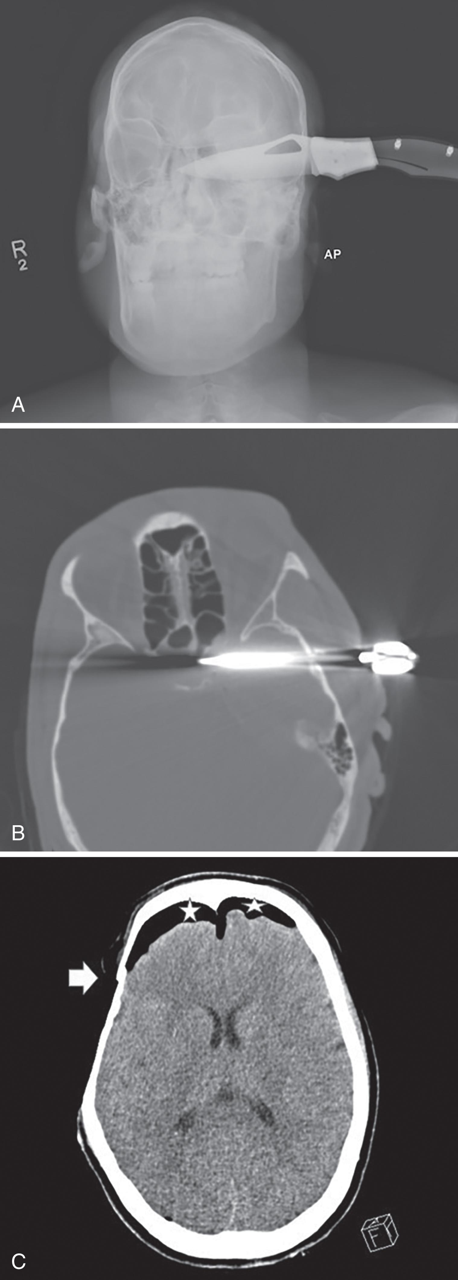 FIGURE 9, Anteroposterior skull radiograph (A) demonstrates a stab wound through the head with embedded knife. Noncontrast CT bone windows (B) demonstrate the intracranial course of the knife through the left temporal lobe and into the left cavernous sinus. (C) Right frontal bone fracture (arrow) results in bifrontal pneumocephalus (star). The pneumocephalus elicits mass effect on the frontal lobes.