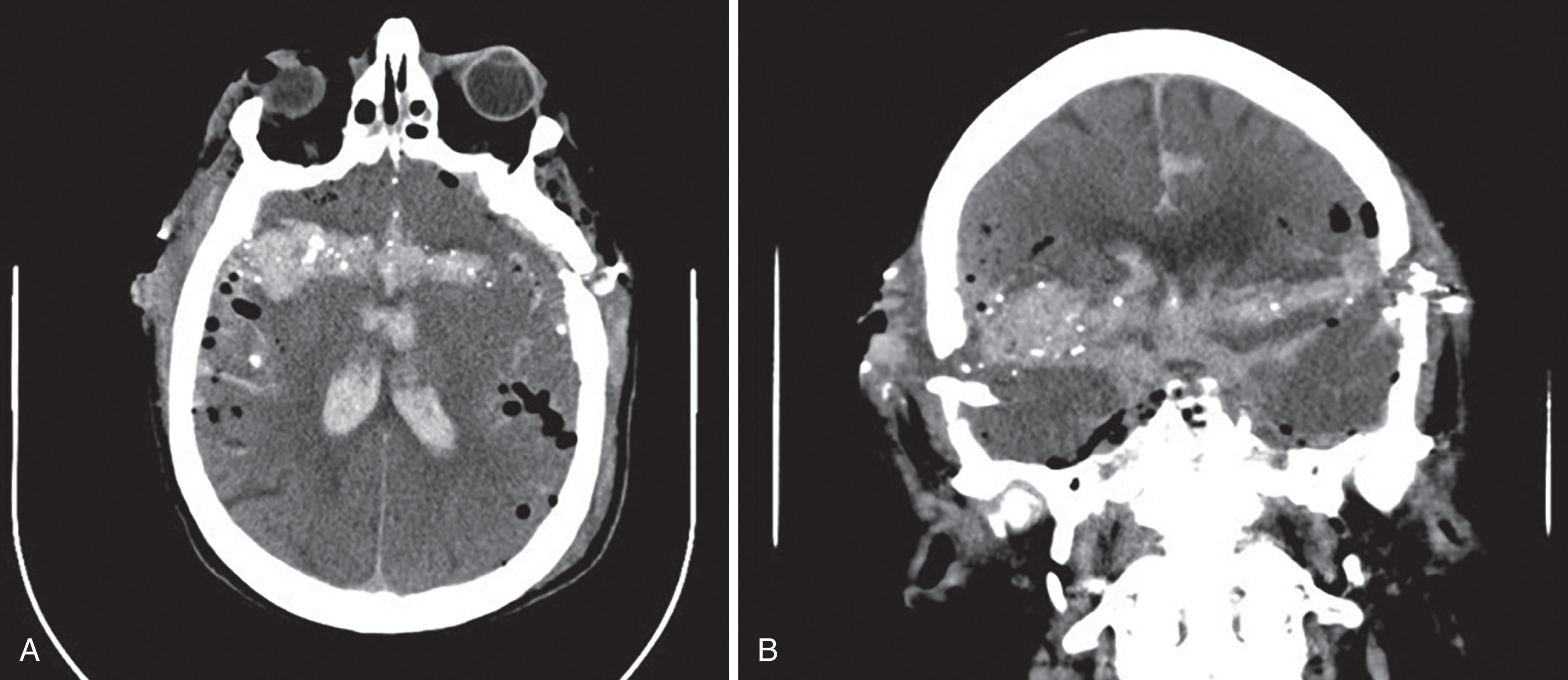 FIGURE 10, (A, B) Noncontrast axial and coronal multiplanar reformat CT images of the brain status post-gunshot wound to the head. The bullet trajectory is delineated by intra- and extra-axial hemorrhage, bone fragments, and bullet shrapnel. There are comminuted fractures of both temporal bones, pneumocephalus, parenchymal lacerations, and parenchymal, intraventricular, subarachnoid, and subdural/epidural hemorrhages.